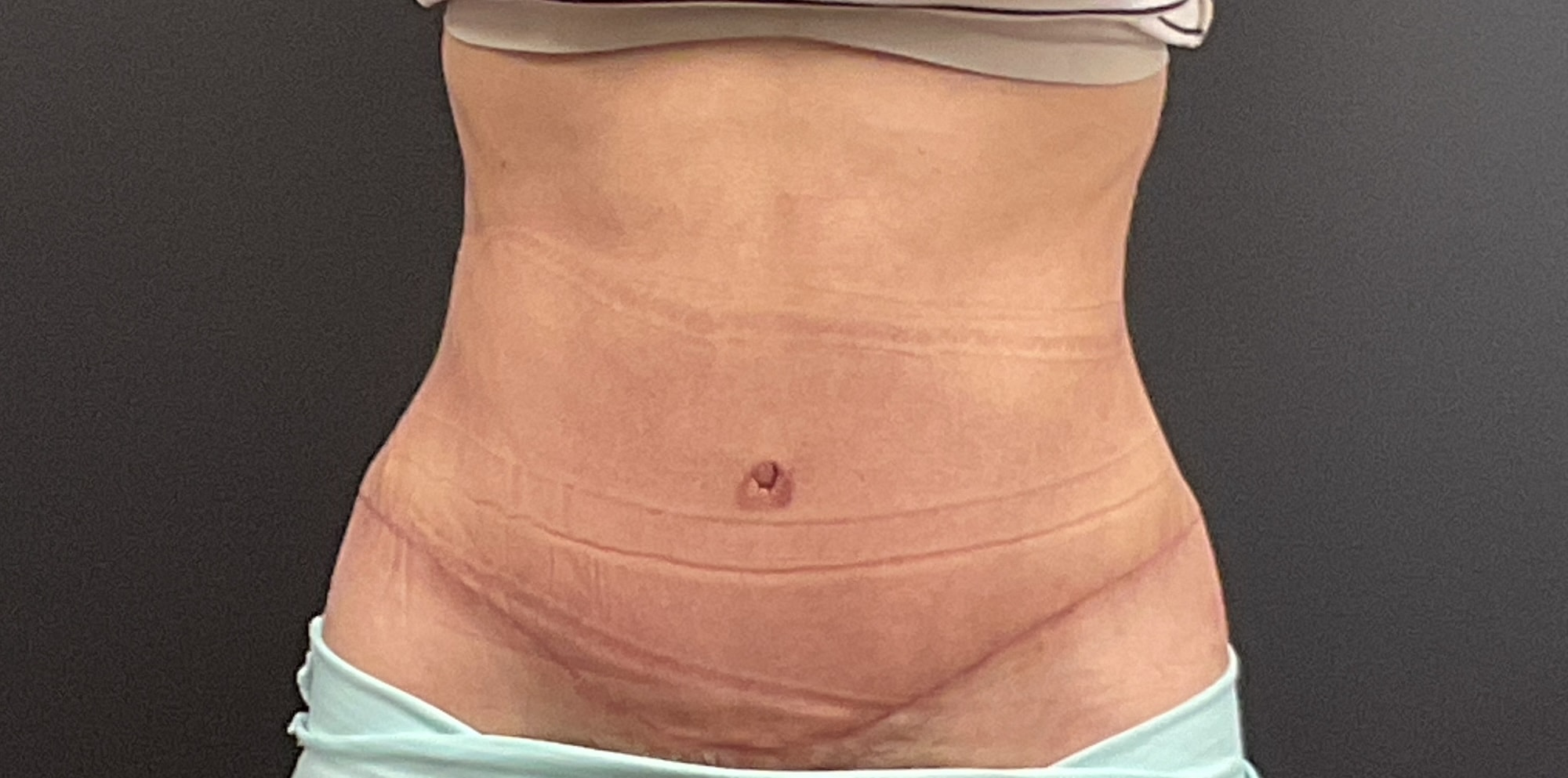 A result from Plastic Surgery Center