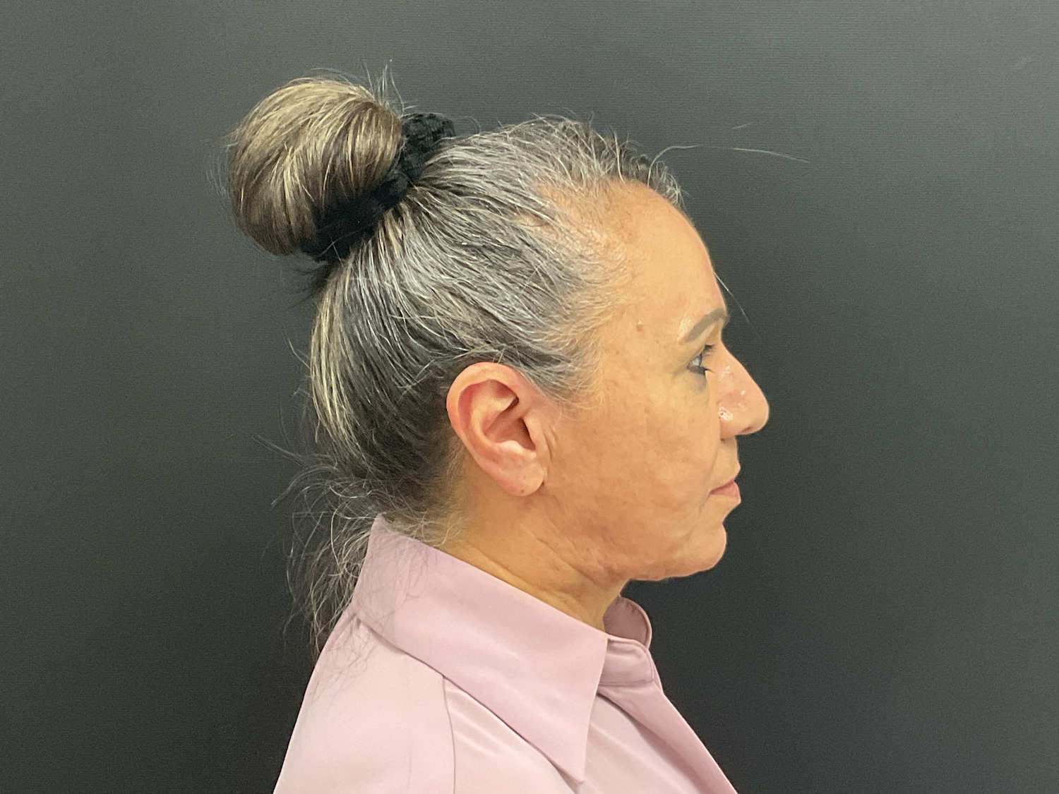 A result from Plastic Surgery Center