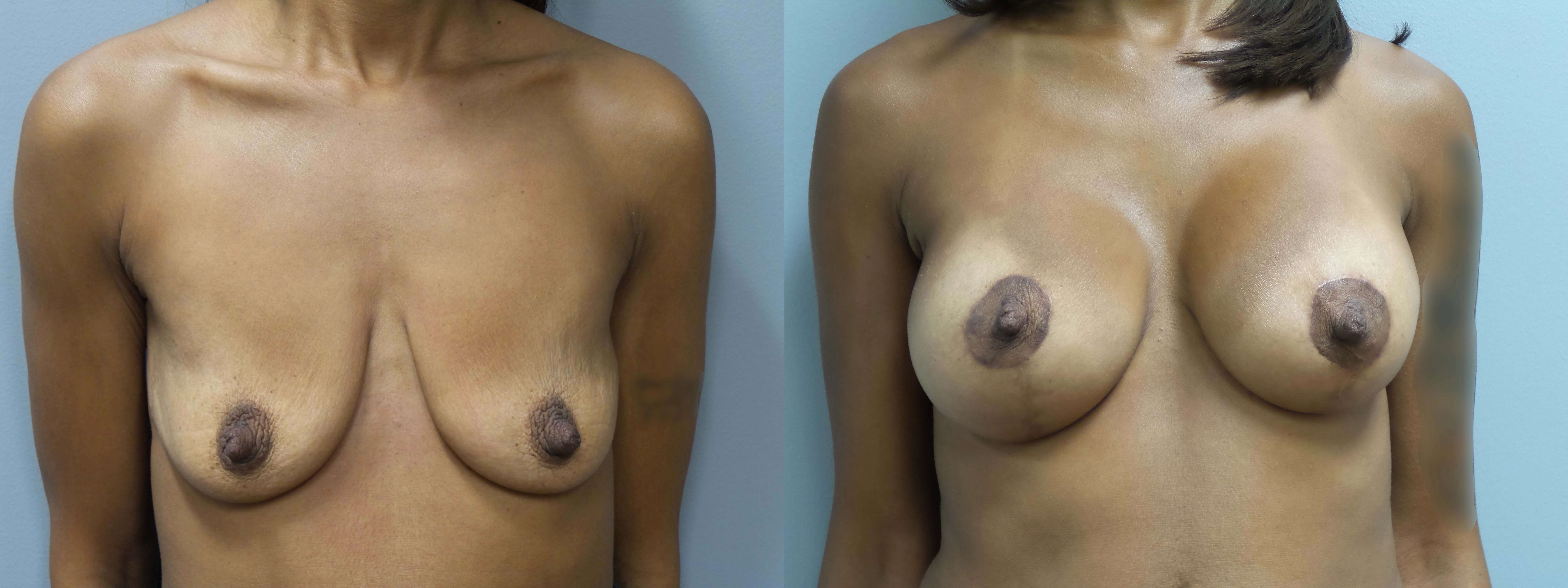 A result from Main Line Institute of Plastic Surgery
