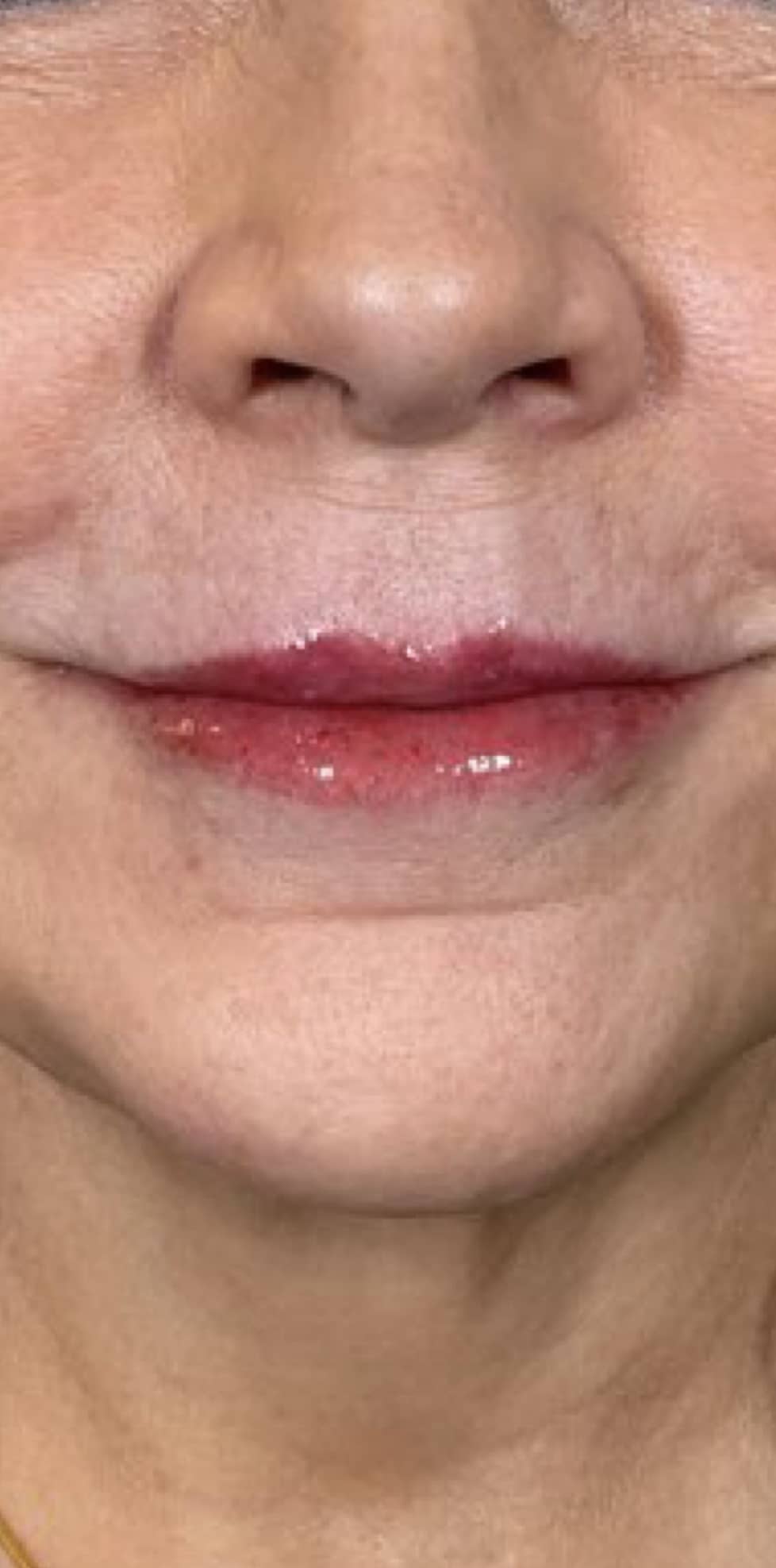 Aspen Dermatology cheek filler after — Spanish Fork, UT