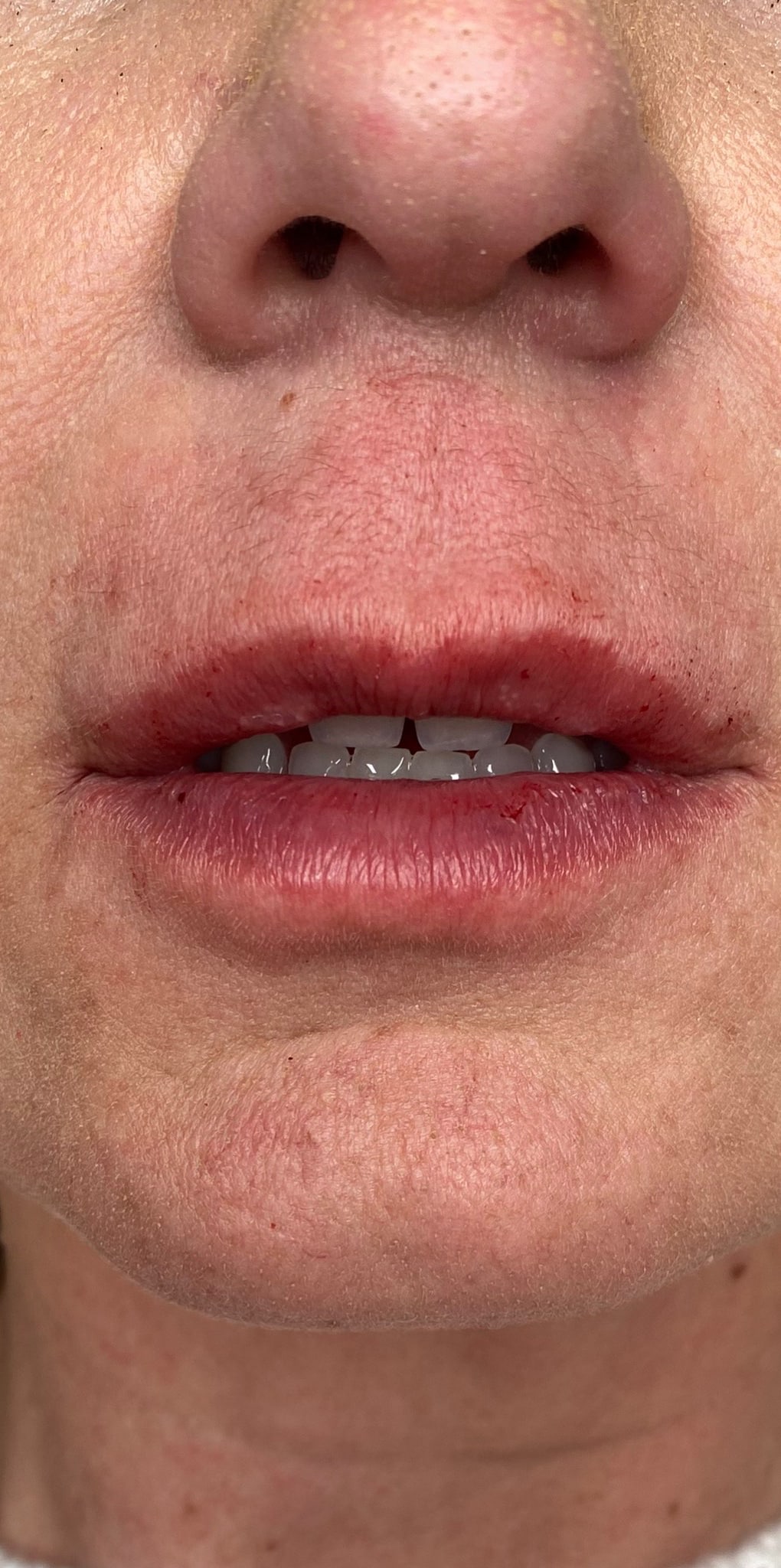 Aspen Dermatology cheek filler after — Spanish Fork, UT