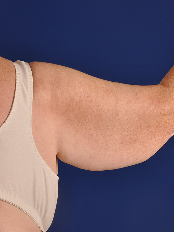 A result from Shapiro Plastic Surgery