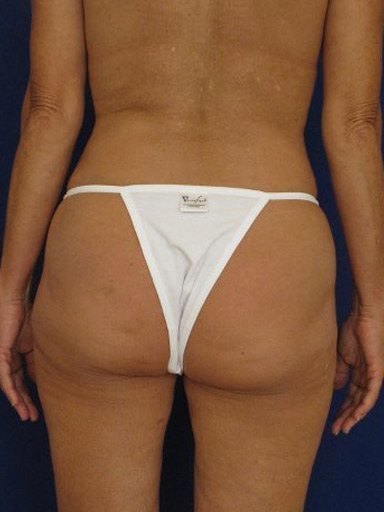 A result from Shapiro Plastic Surgery