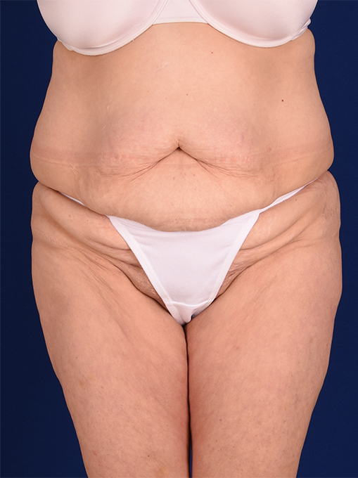 A result from Shapiro Plastic Surgery