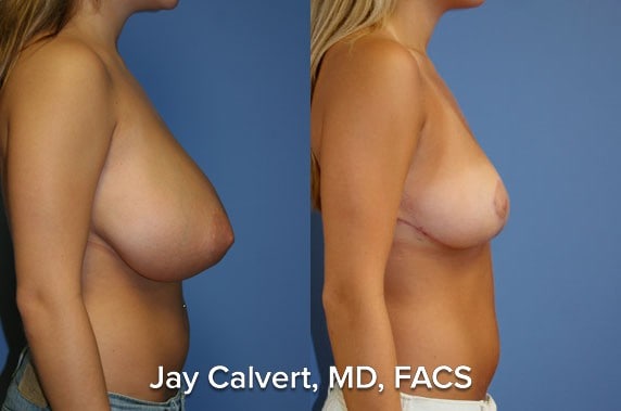 Breast Reduction result at Jay Calvert, MD, Professional Corporation