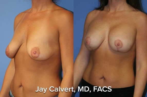 Breast Lift result at Jay Calvert, MD, Professional Corporation