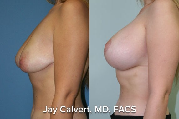 Breast Lift result at Jay Calvert, MD, Professional Corporation