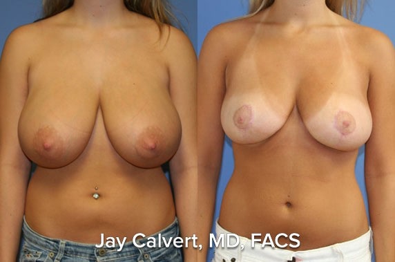 Breast Reduction result at Jay Calvert, MD, Professional Corporation