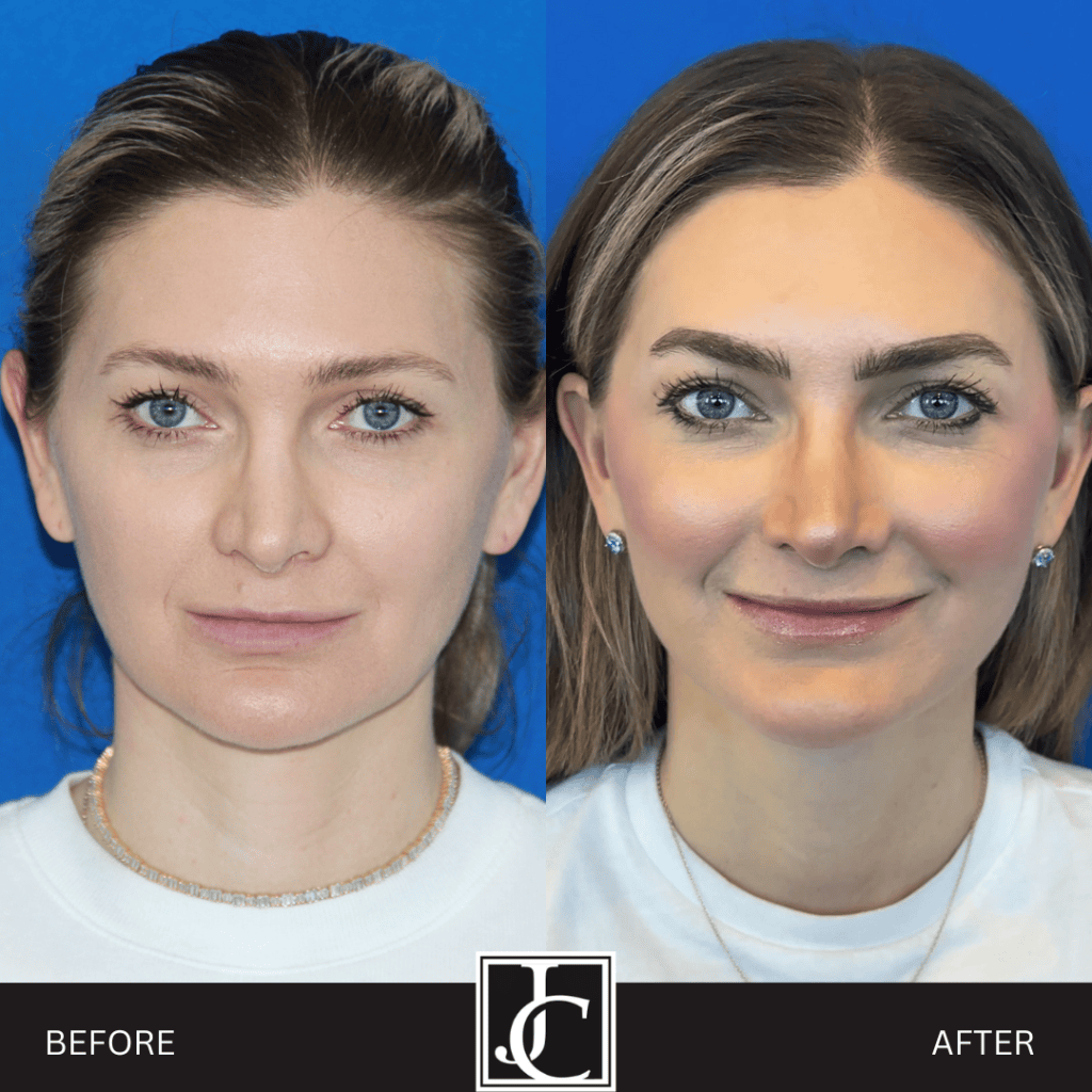Facelift result at Jay Calvert, MD, Professional Corporation