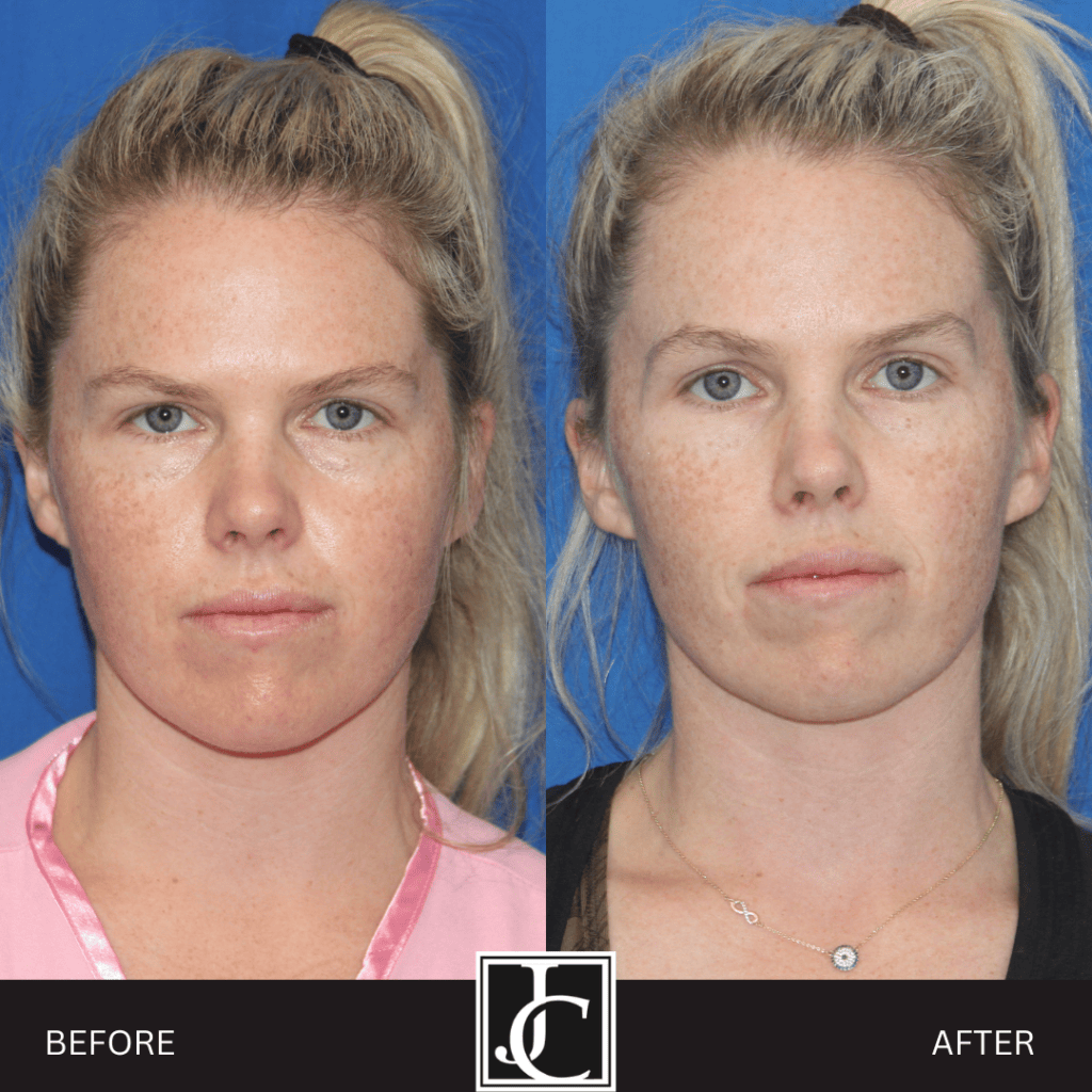 Facelift result at Jay Calvert, MD, Professional Corporation