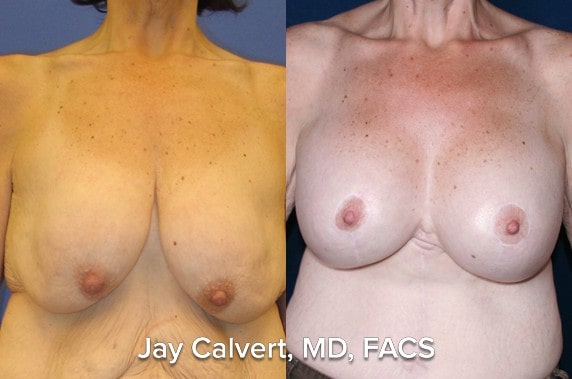 Breast Lift result at Jay Calvert, MD, Professional Corporation