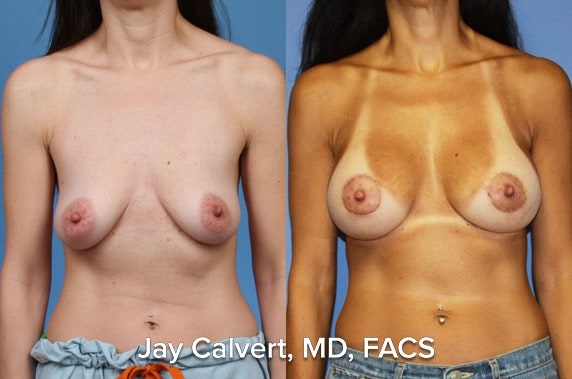 Breast Augmentation result at Jay Calvert, MD, Professional Corporation