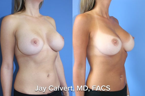 Breast Augmentation result at Jay Calvert, MD, Professional Corporation