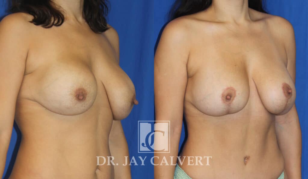 Breast Augmentation result at Jay Calvert, MD, Professional Corporation