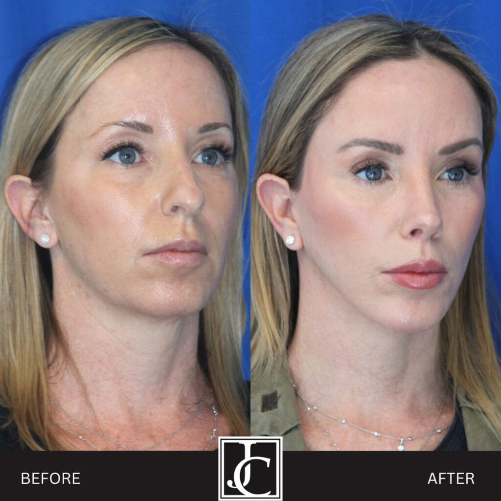 Facelift result at Jay Calvert, MD, Professional Corporation