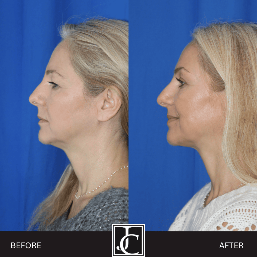 Facelift result at Jay Calvert, MD, Professional Corporation