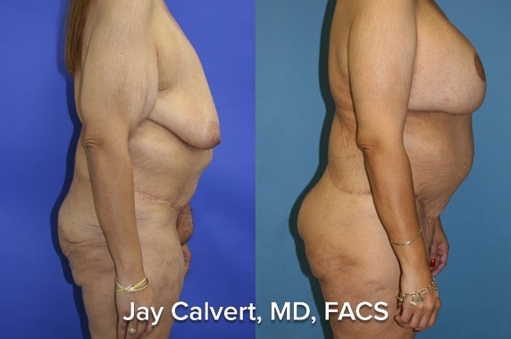 Body Contouring result at Jay Calvert, MD, Professional Corporation