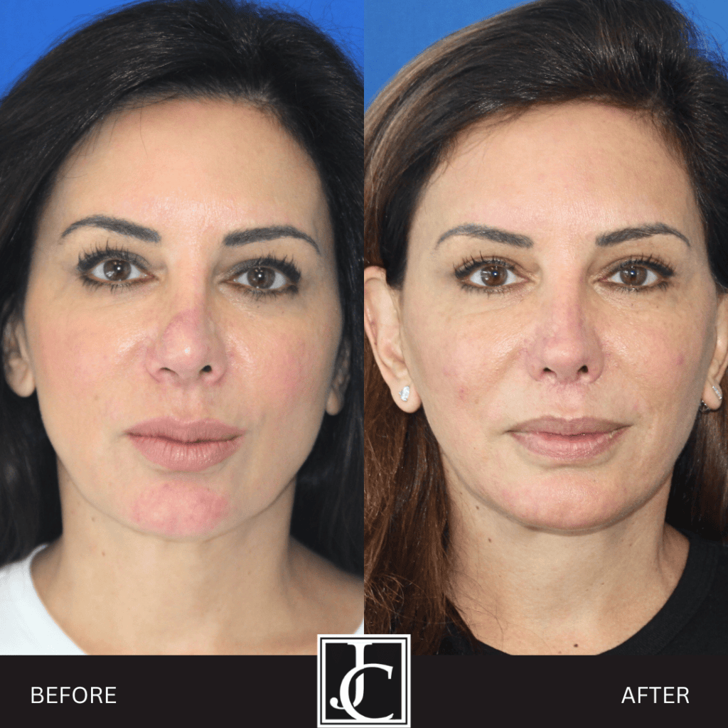 Facelift result at Jay Calvert, MD, Professional Corporation