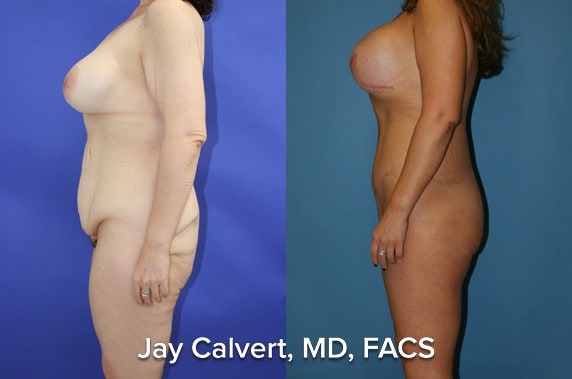 Body Contouring result at Jay Calvert, MD, Professional Corporation