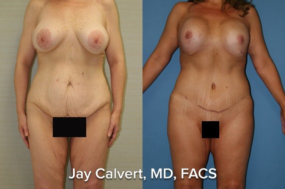Body Contouring result at Jay Calvert, MD, Professional Corporation