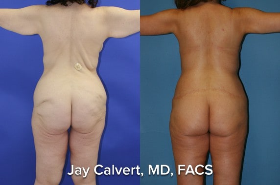Body Contouring result at Jay Calvert, MD, Professional Corporation