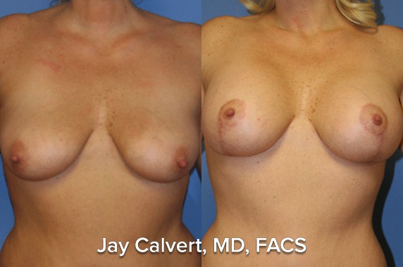 Breast Lift result at Jay Calvert, MD, Professional Corporation