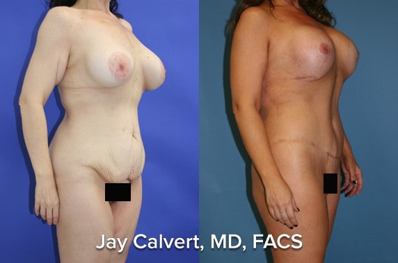 Body Contouring result at Jay Calvert, MD, Professional Corporation