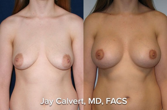 Breast Augmentation result at Jay Calvert, MD, Professional Corporation