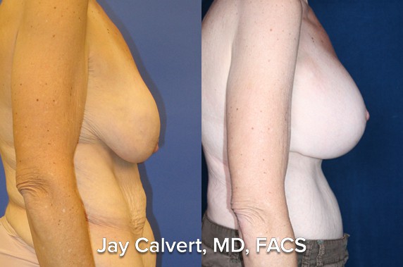 Breast Lift result at Jay Calvert, MD, Professional Corporation