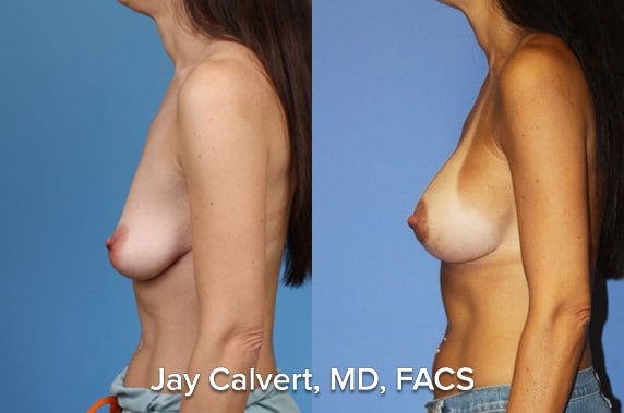 Breast Augmentation result at Jay Calvert, MD, Professional Corporation