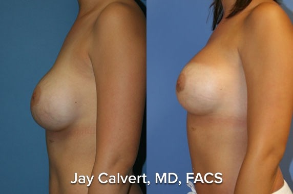 Breast Lift result at Jay Calvert, MD, Professional Corporation