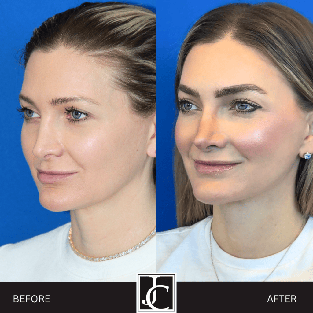 Facelift result at Jay Calvert, MD, Professional Corporation
