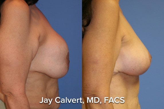 Breast Lift result at Jay Calvert, MD, Professional Corporation