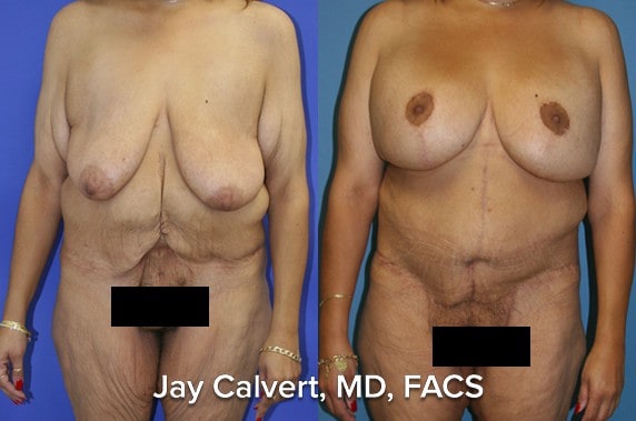 Body Contouring result at Jay Calvert, MD, Professional Corporation