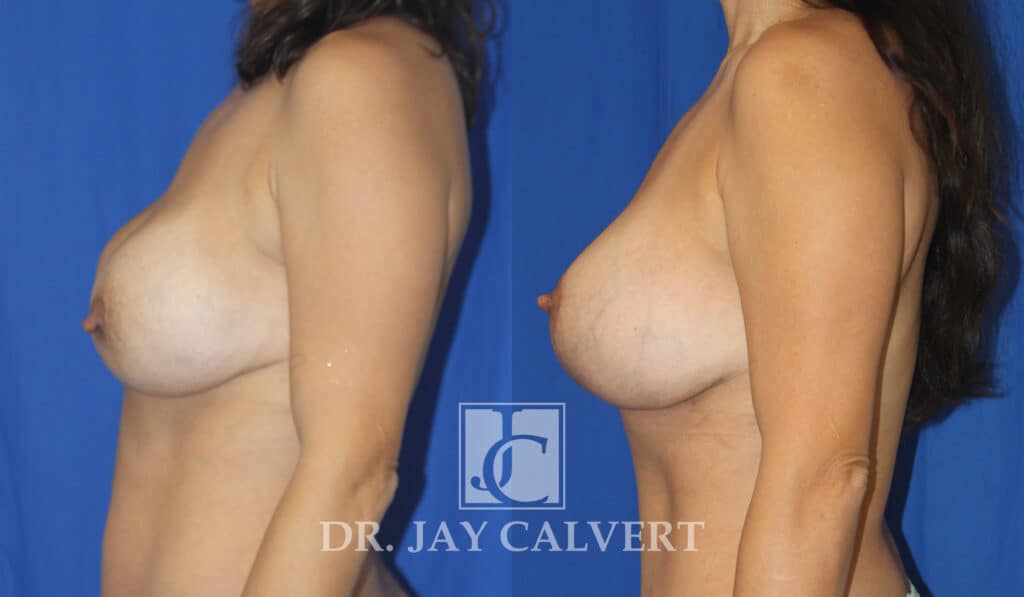 Breast Augmentation result at Jay Calvert, MD, Professional Corporation