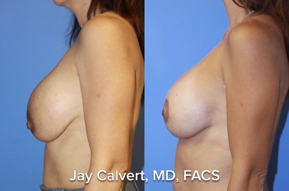 Breast Augmentation result at Jay Calvert, MD, Professional Corporation