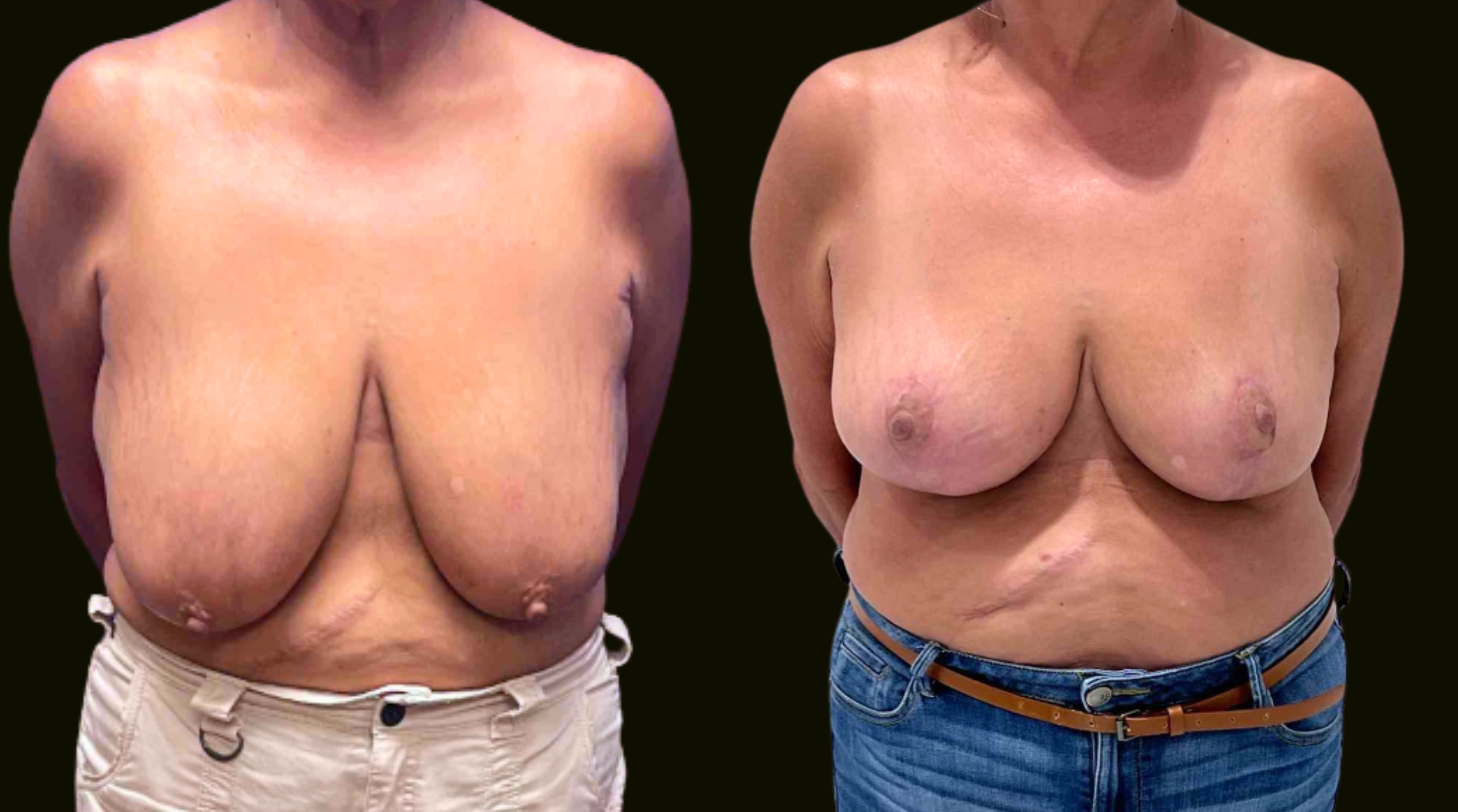 A result from Sanam Zahedi, MD - Zahedi Plastic Surgery