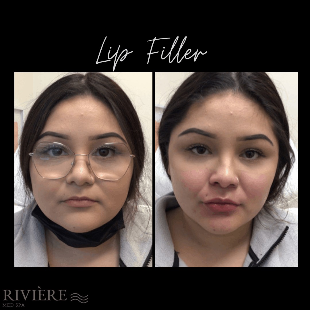 A result from Rivière Med Spa