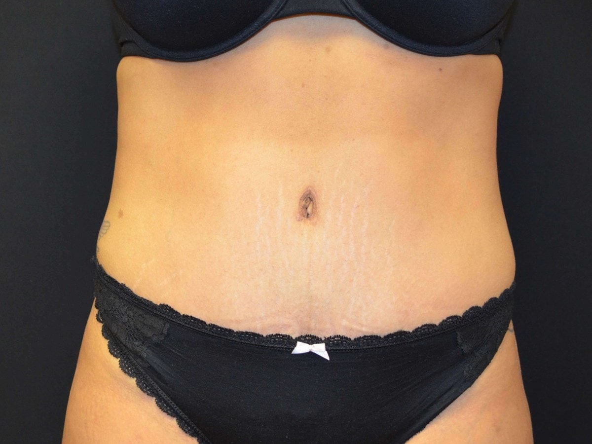 A result from Kouris M.D. Cosmetic Plastic Surgery