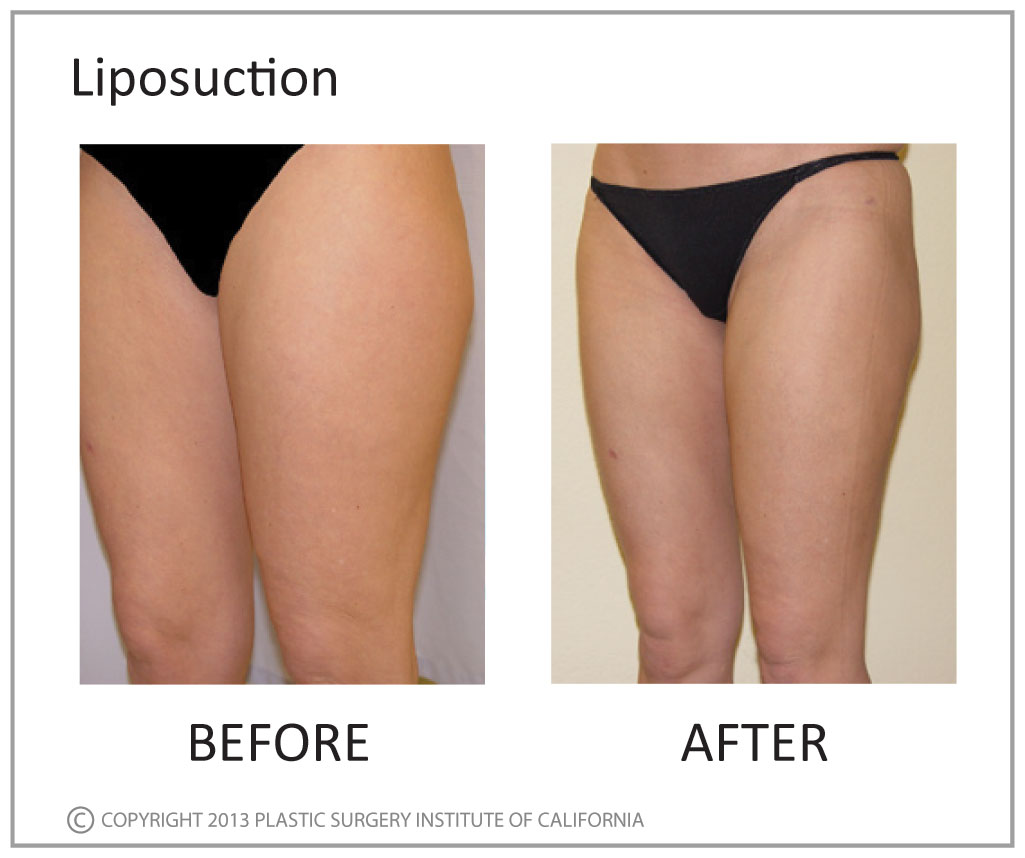 Advanced Medical Institute liposuction after — Pasadena, CA