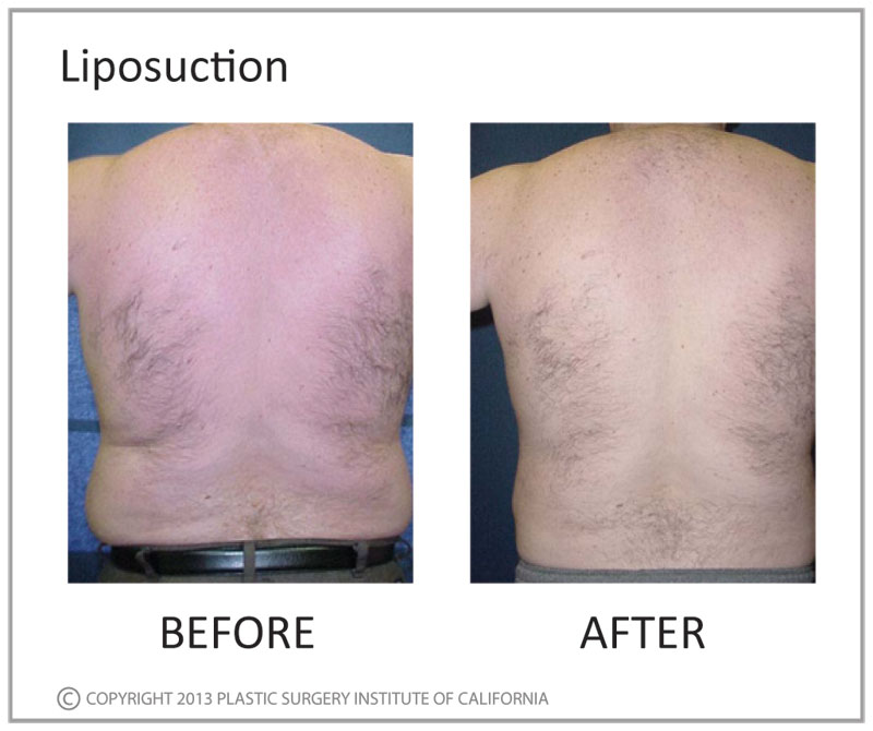 Advanced Medical Institute liposuction after — Pasadena, CA