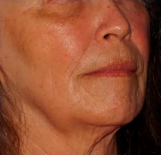 A result from Silk Touch Cosmetic Surgery & Medspa