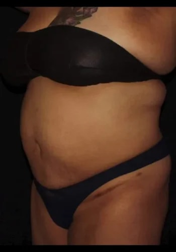 A result from Silk Touch Cosmetic Surgery & Medspa