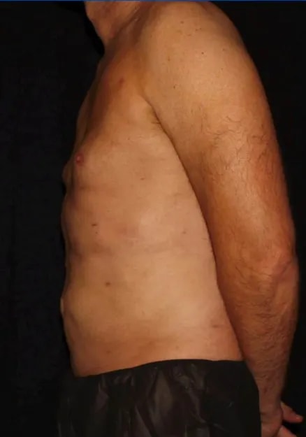 A result from Silk Touch Cosmetic Surgery & Medspa