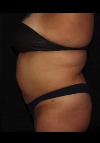 A result from Silk Touch Cosmetic Surgery & Medspa
