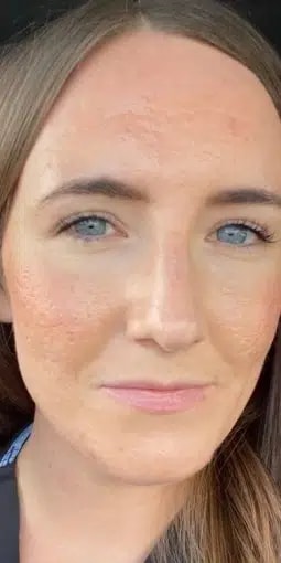 A result from Silk Touch Cosmetic Surgery & Medspa