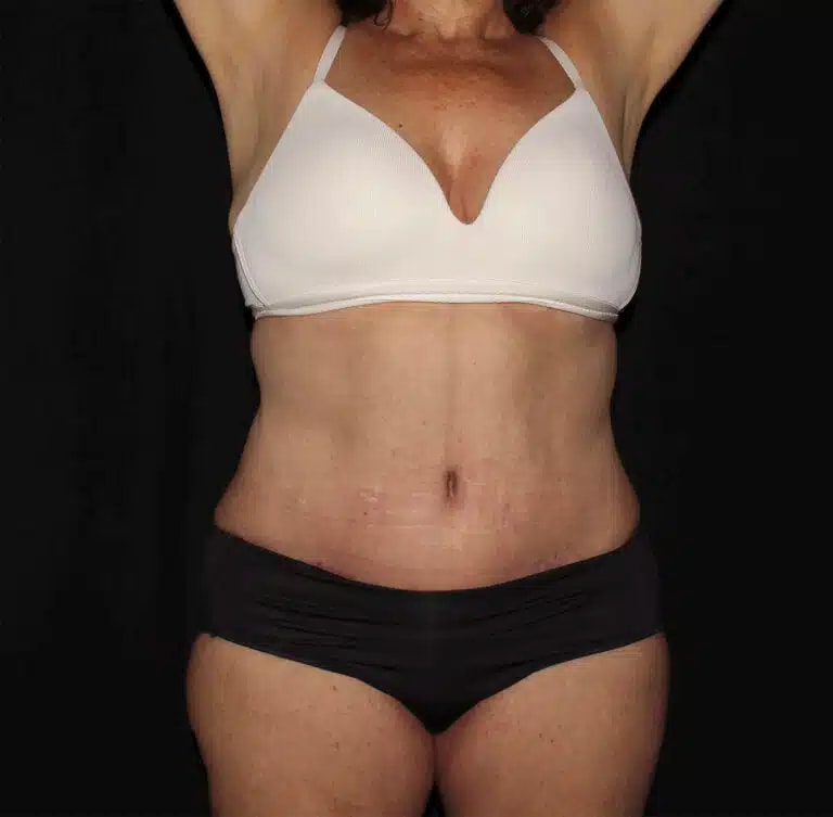 A result from Silk Touch Cosmetic Surgery & Medspa