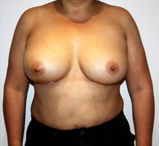 Breast Augmentation Revision result at Dr. Cat Plastic Surgery