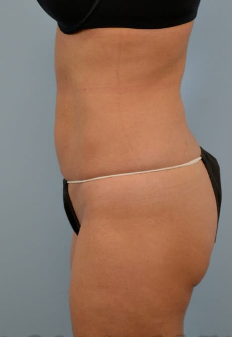 Dr. Cat Plastic Surgery liposuction after — Beverly Hills, CA