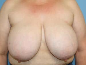 Breast Reduction before photo